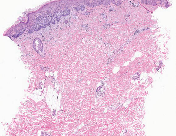 A punch biopsy (above) from the left shoulder showing skin cancer, illuminated in purple, at a magnification of 100x. 